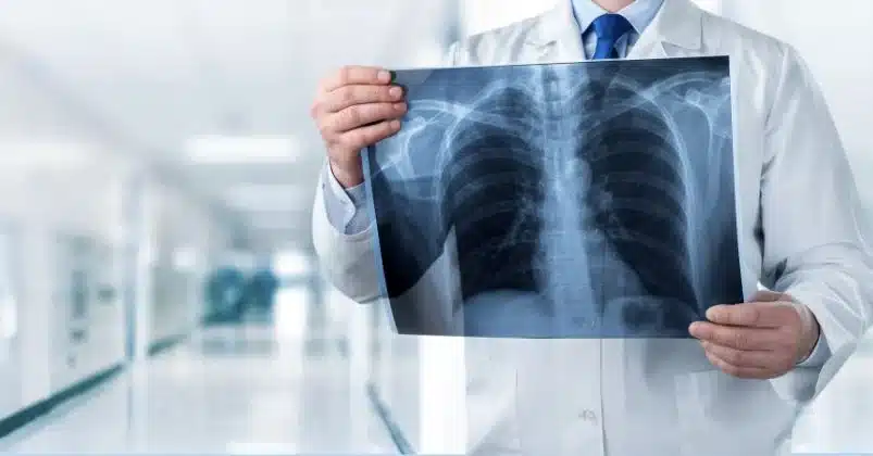 The doctor, wearing a white coat, is holding a chest X-ray